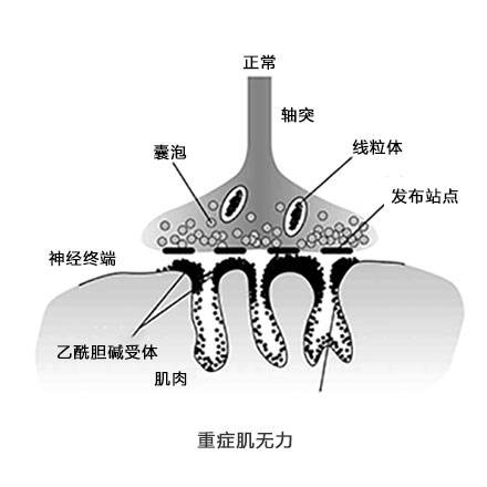重癥肌無(wú)力