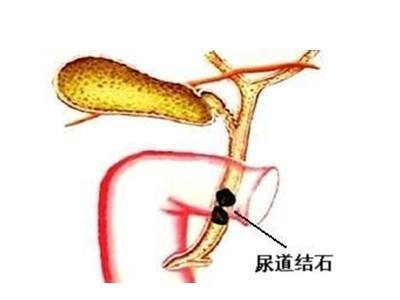 尿道結(jié)石