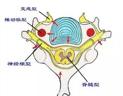 交感神經(jīng)型頸椎病