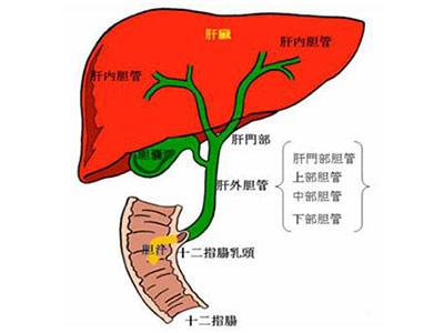 肝外膽管結(jié)石