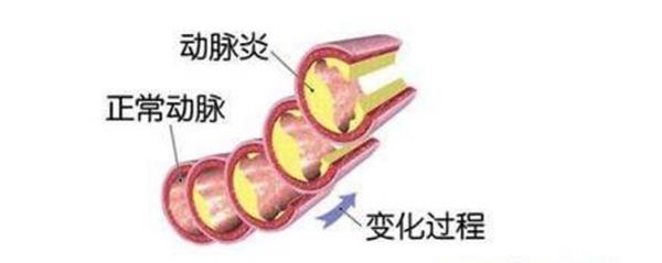 主動(dòng)脈炎