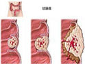 結(jié)腸癌