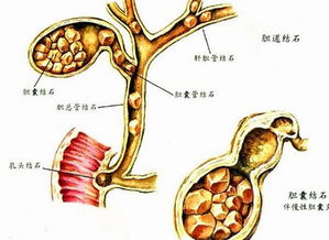 肝內(nèi)膽管結(jié)石